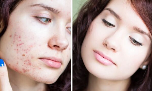 A Complete Guide for the Right Acne Treatment in Lahore